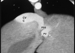 Figure1-CT-Left-IHPSS